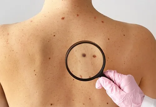 Imagem Câncer de pele